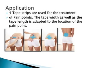  4 Tape strips are used for the treatment
 of Pain points. The tape width as well as the
tape length is adapted to the location of the
pain point.
 