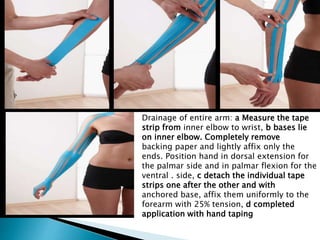 Drainage of entire arm: a Measure the tape
strip from inner elbow to wrist, b bases lie
on inner elbow. Completely remove
backing paper and lightly affix only the
ends. Position hand in dorsal extension for
the palmar side and in palmar flexion for the
ventral . side, c detach the individual tape
strips one after the other and with
anchored base, affix them uniformly to the
forearm with 25% tension, d completed
application with hand taping
 