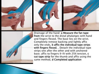 Drainage of the hand: a Measure the fan tape
from the wrist to the distal phalanges with hand
and fingers flexed. The base lies on the wrist.
Completely remove backing and lightly affix
only the ends, b affix the individual tape strips
with fingers flexed. . Detach the individual tape
strips one after the other and with anchored
base; affix to fingers II-IV with 25% tension, c
cut tape strip for the thumb and affix using the
same method, d Completed application
 