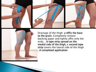 Drainage of the thigh: a Affix the base
to the groin. Completely remove
backing paper and lightly affix only the
ends, . b tape strip spread on the
medial side of the thigh, c second tape
strip covers the lateral side of the thigh
, d completed application
 