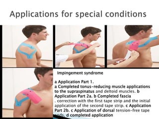 a Application Part 1.
a Completed tonus-reducing muscle applications
to the supraspinatus and deltoid muscles. b
Application Part 2a. b Completed fascia
. correction with the first tape strip and the initial
application of the second tape strip. c Application
Part 2b. c Application of dorsal tension-free tape
ends, d completed application
Impingement syndrome
 