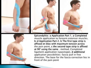 Epicondylitis: a Application Part 1. a Completed
muscle application to forearm extensor muscles.
b-d Application Part 2. b The first tape strip is
affixed en bloc with maximum tension across
the pain point, c the second tape strip is affixed
at 90° using the same . method. Completed
ligament application (spacetape), d additional
application possibilities: fascia pull in free
direction. The base for the fascia correction lies in
front of the pain point
 