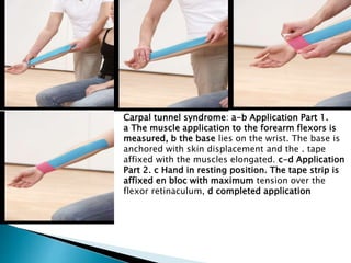 Carpal tunnel syndrome: a-b Application Part 1.
a The muscle application to the forearm flexors is
measured, b the base lies on the wrist. The base is
anchored with skin displacement and the . tape
affixed with the muscles elongated. c-d Application
Part 2. c Hand in resting position. The tape strip is
affixed en bloc with maximum tension over the
flexor retinaculum, d completed application
 