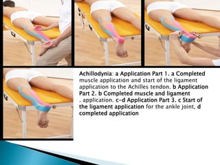 Achillodynia: a Application Part 1. a Completed
muscle application and start of the ligament
application to the Achilles tendon. b Application
Part 2. b Completed muscle and ligament
. application. c-d Application Part 3. c Start of
the ligament application for the ankle joint, d
completed application
 