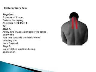 Requires;
2 pieces of I tape
Partner for taping
Posterior Neck Pain 1
22
Step 1.
Apply two I tapes alongside the spine
below the
hair line towards the back while
bending the
neck forward.
Step 2.
No stretch is applied during
application.
Posterior Neck Pain
 