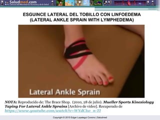 Copyright © 2015 Edgar Lopategui Corsino | Saludmed
ESGUINCE LATERAL DEL TOBILLO CON LINFOEDEMA
(LATERAL ANKLE SPRAIN WITH LYMPHEDEMA)
NOTA: Reproducido de: The Brace Shop. (2010, 28 de julio). Mueller Sports Kinesiology
Taping For Lateral Ankle Sprains [Archivo de video]. Recuperado de
https://www.youtube.com/watch?v=WYdCIw_n-TI
 