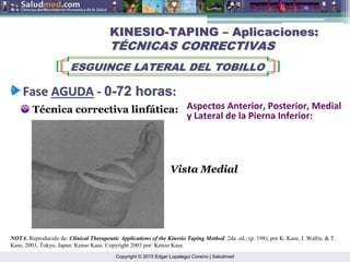 Copyright © 2015 Edgar Lopategui Corsino | Saludmed
Técnica correctiva linfática:
KINESIO
KINESIO-
-TAPING
TAPING –
– Aplicaciones:
Aplicaciones:
T
TÉ
ÉCNICAS CORRECTIVAS
CNICAS CORRECTIVAS
ESGUINCE LATERAL DEL TOBILLO
ESGUINCE LATERAL DEL TOBILLO
Fase
Fase AGUDA
AGUDA ‐
‐ 0
0-
-72
72 horas
horas:
:
NOTA. Reproducido de: Clinical Therapeutic Applications of the Kinesio Taping Method. 2da. ed.; (p. 198), por K. Kase, J. Wallis, & T.
Kase, 2003, Tokyo, Japan: Kenso Kase. Copyright 2003 por: Kenzo Kase.
Vista Medial
Aspectos Anterior, Posterior, Medial
y Lateral de la Pierna Inferior:
 