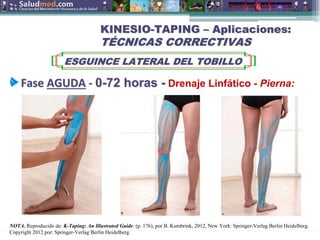 Copyright © 2015 Edgar Lopategui Corsino | Saludmed
NOTA. Reproducido de: K-Taping: An Illustrated Guide. (p. 176), por B. Kumbrink, 2012, New York: Springer-Verlag Berlin Heidelberg.
Copyright 2012 por: Springer-Verlag Berlin Heidelberg.
KINESIO
KINESIO-
-TAPING
TAPING –
– Aplicaciones:
Aplicaciones:
T
TÉ
ÉCNICAS CORRECTIVAS
CNICAS CORRECTIVAS
ESGUINCE LATERAL DEL TOBILLO
ESGUINCE LATERAL DEL TOBILLO
Fase
Fase AGUDA
AGUDA ‐
‐ 0
0-
-72
72 horas
horas -
- Drenaje Linfático - Pierna:
 