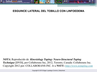 Copyright © 2015 Edgar Lopategui Corsino | Saludmed
ESGUINCE LATERAL DEL TOBILLO CON LINFOEDEMA
NOTA. Reproducido de: Kinesiology Taping: Neuro-Structural Taping
Technique [DVD], por Collaborans Inc, 2012, Toronto, Canada: Collaborans Inc.
Copyright 2012 por: COLLABORANS INC. Ir a NSTT: http://www.nstaping.com
 