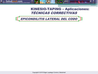 Copyright © 2015 Edgar Lopategui Corsino | Saludmed
KINESIO
KINESIO-
-TAPING
TAPING –
– Aplicaciones:
Aplicaciones:
T
TÉ
ÉCNICAS CORRECTIVAS
CNICAS CORRECTIVAS
EPICONDILITIS LATERAL DEL CODO
EPICONDILITIS LATERAL DEL CODO
 