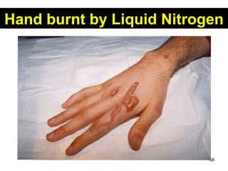 Hand burnt by Liquid Nitrogen 