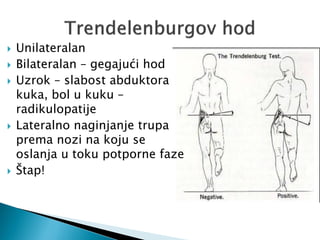  Unilateralan
 Bilateralan – gegajući hod
 Uzrok – slabost abduktora
kuka, bol u kuku –
radikulopatije
 Lateralno naginjanje trupa
prema nozi na koju se
oslanja u toku potporne faze
 Štap!
 