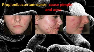 Propionibacterium acnes- cause pimple
and acne
 