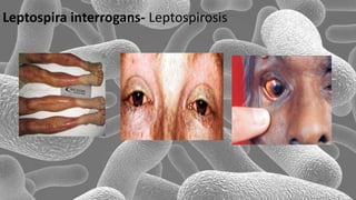 Leptospira interrogans- Leptospirosis
 
