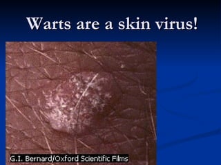 Warts are a skin virus! 