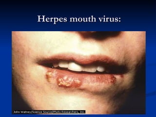 Herpes mouth virus: 