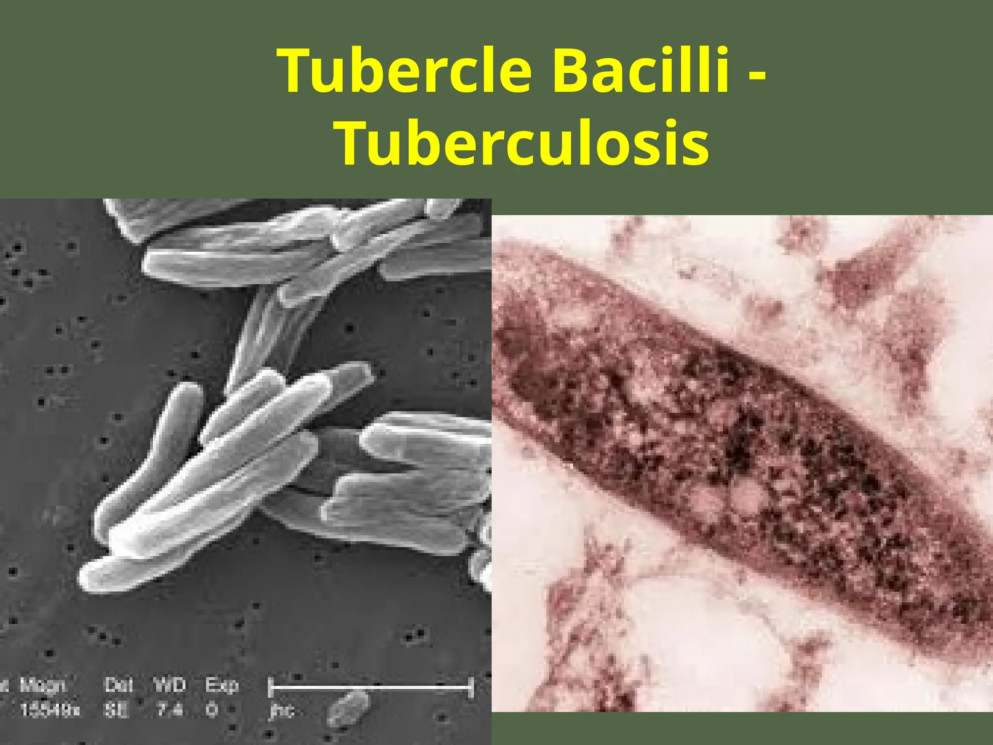 Tubercle Bacilli -
Tuberculosis
 