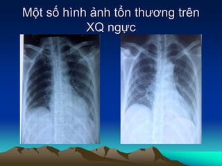 Một số hình ảnh tổn thương trên
XQ ngực
 