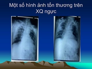 Một số hình ảnh tổn thương trên
XQ ngực
 
