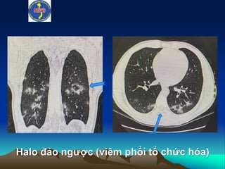 Halo đảo ngược (viêm phổi tổ chức hóa)
 