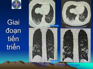 Giai
đoạn
tiến
triển
Lần 01 (sau khởi phát
08 ngày) Lần 02 (cách 05 ngày)
 