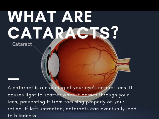 Understanding Cataracts | Measuring the Eye for Cataract Surgery: A ...