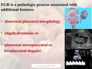 FGR is a pathologic process associated with
additional features
• abnormal placental morphology
• oligohydramnios or
• abnormal uteroplacental or
fetoplacental doppler
Dr. Kirtan Vyas # 9825407702
 