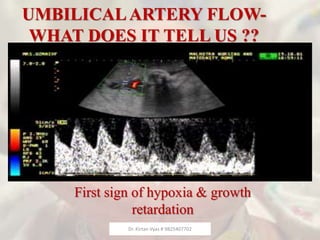 UMBILICALARTERY FLOW-
WHAT DOES IT TELL US ??
First sign of hypoxia & growth
retardation
Dr. Kirtan Vyas # 9825407702
 