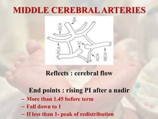 MIDDLE CEREBRALARTERIES
Reflects : cerebral flow
End points : rising PI after a nadir
– More than 1.45 before term
– Fall down to 1
– If less than 1- peak of redistribution
 