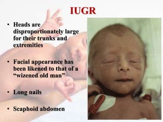 IUGR
• Heads are
disproportionately large
for their trunks and
extremities
• Facial appearance has
been likened to that of a
“wizened old man”
• Long nails
• Scaphoid abdomen
 