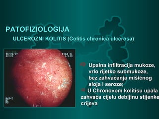 PATOFIZIOLOGIJAPATOFIZIOLOGIJA
ULCEROZNI KOLITIS (Colitis chronica ulcerosa)ULCEROZNI KOLITIS (Colitis chronica ulcerosa)
 Upalna infiltracija mukoze,Upalna infiltracija mukoze,
vrlo rijetko submukoze,vrlo rijetko submukoze,
bez zahvaćanja mišićnogbez zahvaćanja mišićnog
sloja i seroze;sloja i seroze;
 U Chronovom kolitisu upalaU Chronovom kolitisu upala
zahvaća cijelu debljinu stijenkezahvaća cijelu debljinu stijenke
crijevacrijeva
 