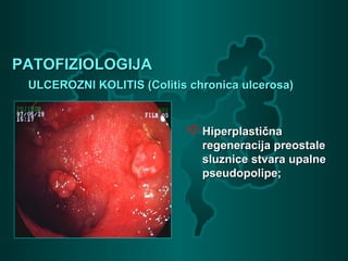 PATOFIZIOLOGIJAPATOFIZIOLOGIJA
ULCEROZNI KOLITIS (Colitis chronica ulcerosa)ULCEROZNI KOLITIS (Colitis chronica ulcerosa)
HiperplastičnaHiperplastična
regeneracija preostaleregeneracija preostale
sluznice stvara upalnesluznice stvara upalne
pseudopolipe;pseudopolipe;
 