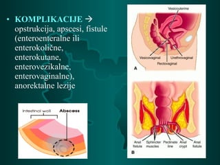 • KOMPLIKACIJE 
opstrukcija, apscesi, fistule
(enteroenteralne ili
enterokolične,
enterokutane,
enterovezikalne,
enterovaginalne),
anorektalne lezije
 