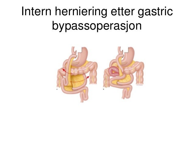 Kirurgisk behandling av sykelig overvekt