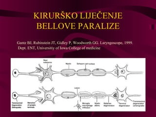 KIRURŠKO LIJEČENJE 
BELLOVE PARALIZE 
Gantz BJ, Rubinstein JT, Gidley P, Woodworth GG. Laryngoscope, 1999. 
Dept. ENT, Universitiy of Iowa College of medicine 
 