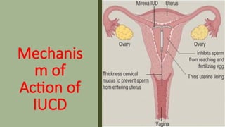 Mechanis
m of
Action of
IUCD
 