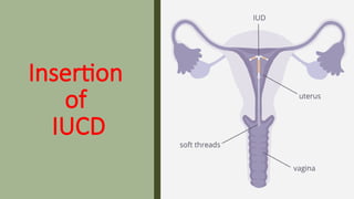Insertion
of
IUCD
 