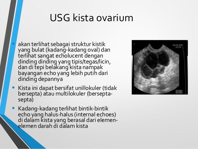 Gambar Usg Kista Ovarium Images Amashusho