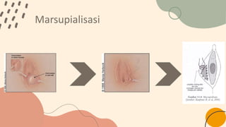 Kista dan abses bartholin