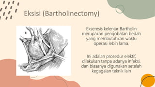 Kista dan abses bartholin