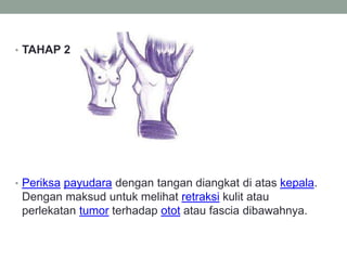 • TAHAP 2
• Periksa payudara dengan tangan diangkat di atas kepala.
Dengan maksud untuk melihat retraksi kulit atau
perlekatan tumor terhadap otot atau fascia dibawahnya.
 