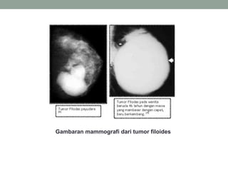 Gambaran mammografi dari tumor filoides
 