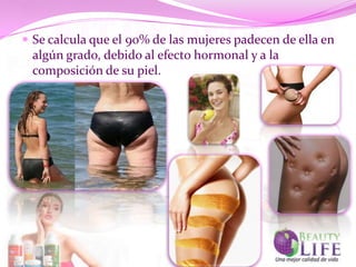  Se calcula que el 90% de las mujeres padecen de ella en
 algún grado, debido al efecto hormonal y a la
 composición de su piel.
 