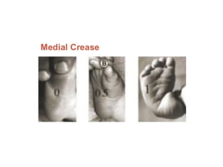 CTEV Imaging, Classification, Pirani scoring system, conservative ...