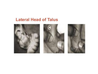 CTEV Imaging, Classification, Pirani scoring system, conservative ...