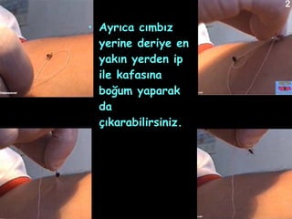 Ayrıca cımbız yerine deriye en yakın yerden ip ile kafasına boğum yaparak da çıkarabilirsiniz. 