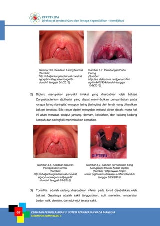 PPPPTK IPA
Direktorat Jenderal Guru dan Tenaga Kependidikan - Kemdikbud
KEGIATAN PEMBELAJARAN 3: SISTEM PERNAFASAN PADA MANUSIA
KELOMPOK KOMPETENSI C
68
Gambar 3.6. Keadaan Faring Normal
(Sumber:
http://obatjantungtradisional.com/cat
egory/uncategorized/page/8/
diunduh tanggal 5/1/2016)
Gambar 3.7. Peradangan Pada
Faring
(Sumber:
http://es.slideshare.net/jgenaro/fari
ngitis-9407454diunduh tanggal
10/9/2015)
2) Dipteri, merupakan penyakit infeksi yang disebabkan oleh bakteri
Corynebacterium diptherial yang dapat menimbulkan penyumbatan pada
rongga faring (faringitis) maupun laring (laringitis) oleh lendir yang dihasilkan
bakteri tersebut. Bila racun dipteri menyebar melalui aliran darah, maka hal
ini akan merusak selaput jantung, demam, kelelahan, dan kadang-kadang
lumpuh dan seringkali menimbulkan kematian.
Gambar 3.8. Keadaan Saluran
Pernapasan Normal
(Sumber:
http://obatjantungtradisional.com/cat
egory/uncategorized/page/8/
diunduh tanggal 5/1/2016)
Gambar 3.9. Saluran pernapasan Yang
Mengalami Infeksi Akibat Dipteri
(Sumber : http://www.hmpd-
untad.org/buletin-disease-x-difteri/diunduh
tanggal 10/9/2015)
3) Tonsilitis, adalah radang disebabkan infeksi pada tonsil disebabkan oleh
bakteri. Gejalanya adalah sakit tenggorokan, sulit menelan, temperatur
badan naik, demam, dan otot-otot terasa sakit.
 