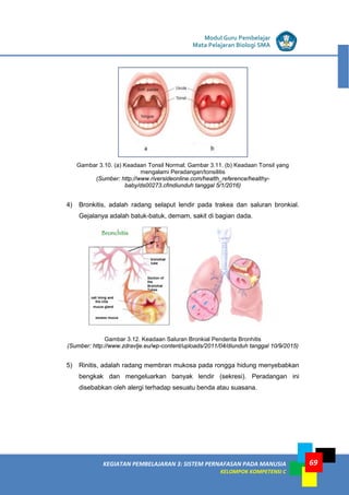 LISTRIK untuk SMP
KEGIATAN PEMBELAJARAN 3: SISTEM PERNAFASAN PADA MANUSIA
KELOMPOK KOMPETENSI C
Modul Guru Pembelajar
Mata Pelajaran Biologi SMA
69
Gambar 3.10. (a) Keadaan Tonsil Normal; Gambar 3.11. (b) Keadaan Tonsil yang
mengalami Peradangan/tonsilitis
(Sumber: http://www.riversideonline.com/health_reference/healthy-
baby/ds00273.cfmdiunduh tanggal 5/1/2016)
4) Bronkitis, adalah radang selaput lendir pada trakea dan saluran bronkial.
Gejalanya adalah batuk-batuk, demam, sakit di bagian dada.
Gambar 3.12. Keadaan Saluran Bronkial Penderita Bronhitis
(Sumber: http://www.zdravlje.eu/wp-content/uploads/2011/04/diunduh tanggal 10/9/2015)
5) Rinitis, adalah radang membran mukosa pada rongga hidung menyebabkan
bengkak dan mengeluarkan banyak lendir (sekresi). Peradangan ini
disebabkan oleh alergi terhadap sesuatu benda atau suasana.
 