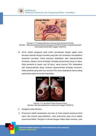 PPPPTK IPA
Direktorat Jenderal Guru dan Tenaga Kependidikan - Kemdikbud
KEGIATAN PEMBELAJARAN 3: SISTEM PERNAFASAN PADA MANUSIA
KELOMPOK KOMPETENSI C
70
Gambar 3.13. Radang Membran Mukosa Pada Penderita Rhinitis
(Sumber : http://penyembuhankankers.blogspot.com/2013/11/cara-mengobati-penyakit-
rinitis-alergi.htmldiunduh tanggal 10/9/2015)
6) Asma, adalah gangguan pada sistem pernapasan dengan gejala sukar
bernapas ditandai dengan kontraksi yang kaku dari bronkiolus menyebabkan
kesukaran bernapas. Asma biasanya disebabkan oleh hipersensitivitas
bronkiolus (disebut asma bronkiale) terhadap benda-benda asing di udara.
Pada penderita di bawah usia 30 tahun, asma kira-kira 70% disebablkan
oleh hipersensitivitas alergi, terutama hipersensivitas terhadap tumbuhan.
Pada penderita yang lebih tua, kira-kira 70% asma disebabkan karena alergi
pada bahan bahan kimia dan kabut/debu.
Gambar 3.14. Bronliolus Pada Penderita Asma
(Sumber: http://penyebabasma.com/diunduh tanggal 10/9/2015)
b. Gangguan pada Alveolus
1) Pneumonia adalah peradangan paru-paru di mana alveolus biasanya berisi
cairan dan eritrosit yang berlebihan. Jenis pneumonia yang umum adalah
pneumonia bakteri. Penyakit ini dimulai dengan infeksi dalam alveolus, yaitu
 