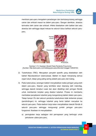 LISTRIK untuk SMP
KEGIATAN PEMBELAJARAN 3: SISTEM PERNAFASAN PADA MANUSIA
KELOMPOK KOMPETENSI C
Modul Guru Pembelajar
Mata Pelajaran Biologi SMA
71
membran paru-paru mengalami peradangan dan berlubang-lubang sehingga
cairan dan eritrosit masuk ke dalam paru-paru. Dengan demikian, alveolus
terinveksi oleh cairan dan eritrosit. Infeksi disebarkan oleh bakteri dari satu
alveolus lain sehingga dapat meluas ke seluruh lobus bahkan seluruh paru-
paru.
Gambar 3.15. Keadaan Alveoli Pada Penderita Pneumonia
(Sumber: http://paru-paru.com/radang-paru-paru//diunduh tanggal 10/9/2015)
2) Tuberkolosis (TBC). Merupakan penyakit spesifik yang disebabkan oleh
bakteri Mycobacterium tuberculosae. Bakteri ini dapat menyerang semua
organ tubuh, tetapi yang paling sering adalah paru-paru dan tulang.
3) Pada tuberculosa, serangan bakteri menyebabkan reaksi jaringan yang aneh
dalam paru-paru. Daerah yang terinfeksi akan diserang oleh makrofag,
sehingga daerah tersebut rusak dan akan dikelilingi oleh jaringan fibrotik
untuk membentuk tonjolan yang disebut tuberkel. Proses ini membantu
membatasi penyebaran tuberkel yang mengandung bakteri dalam paru-paru.
Tetapi hampir 3% dari seluruh penderita tuberkulosis tidak terbentuk proses
(pendindingan) ini, sehingga tuberkel yang berisi bakteri menyebar ke
seluruh paru-paru. Pada stadium lanjut akan menyebabkan daerah fibrotik di
seluruh paru-paru sehingga mengurangi jumlah jaringan paru-paru
fungsional. Keadaan ini menyebabkan:
a) peningkatan kerja sebagian otot pernapasan yang berfungsi untuk
pertukaran udara paru-paru,
 